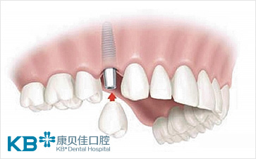 沈阳种植牙一般要花多少钱
