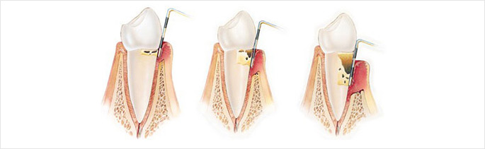 牙周炎治疗后会复发吗?